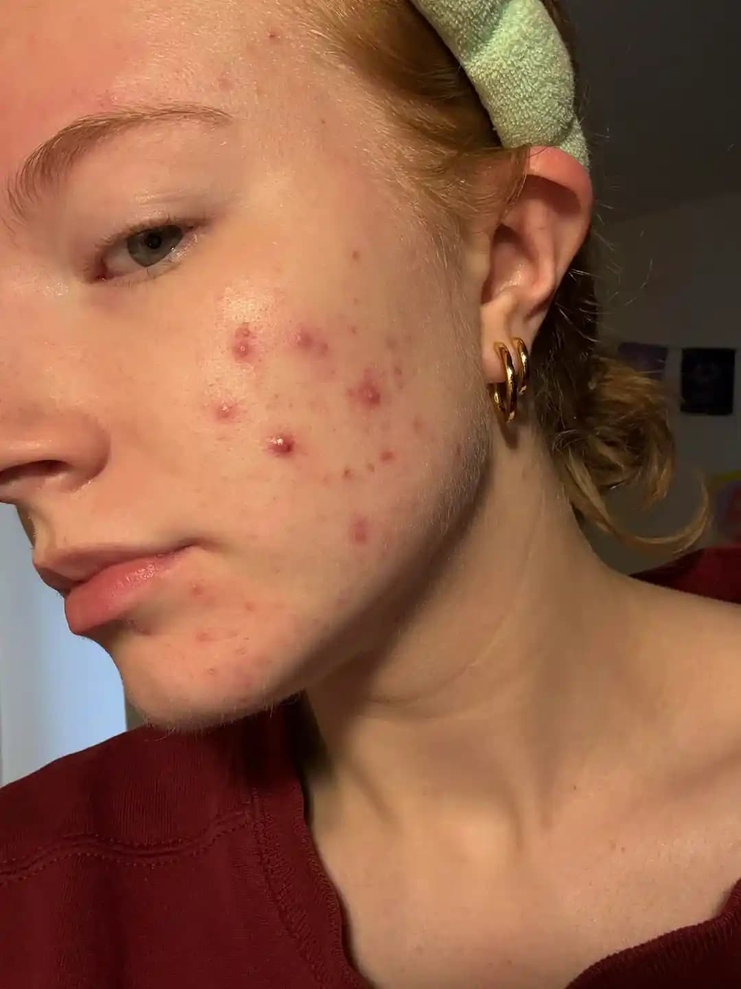 Hormonal Akne Tedavisinde Etkili Yöntemler ve Kişiye Özel Tedavi Seçenekleri