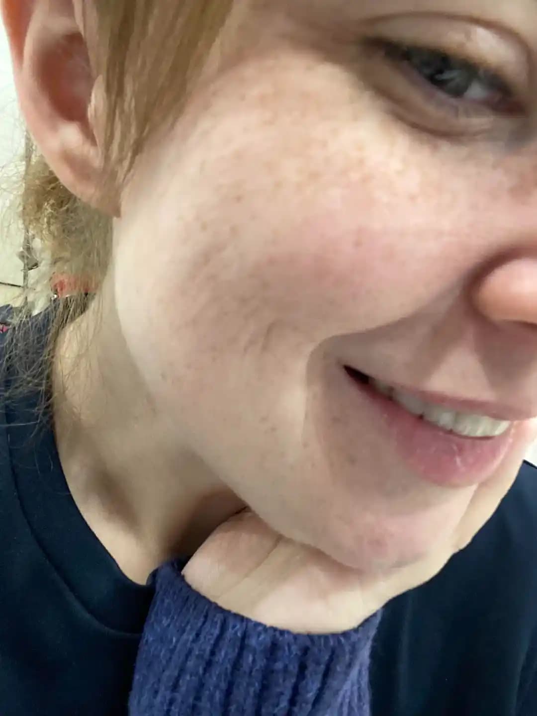 Kilo Kaybı Sonrası Cilt Kırışıklıkları: Nedenleri, Süreci ve Etkili Çözüm Yolları