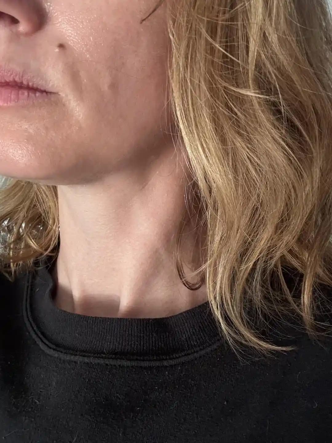 Kilo Kaybı ve Uyku Problemlerinin Cilt Sağlığı Üzerindeki Etkileri ve Çözüm Yolları