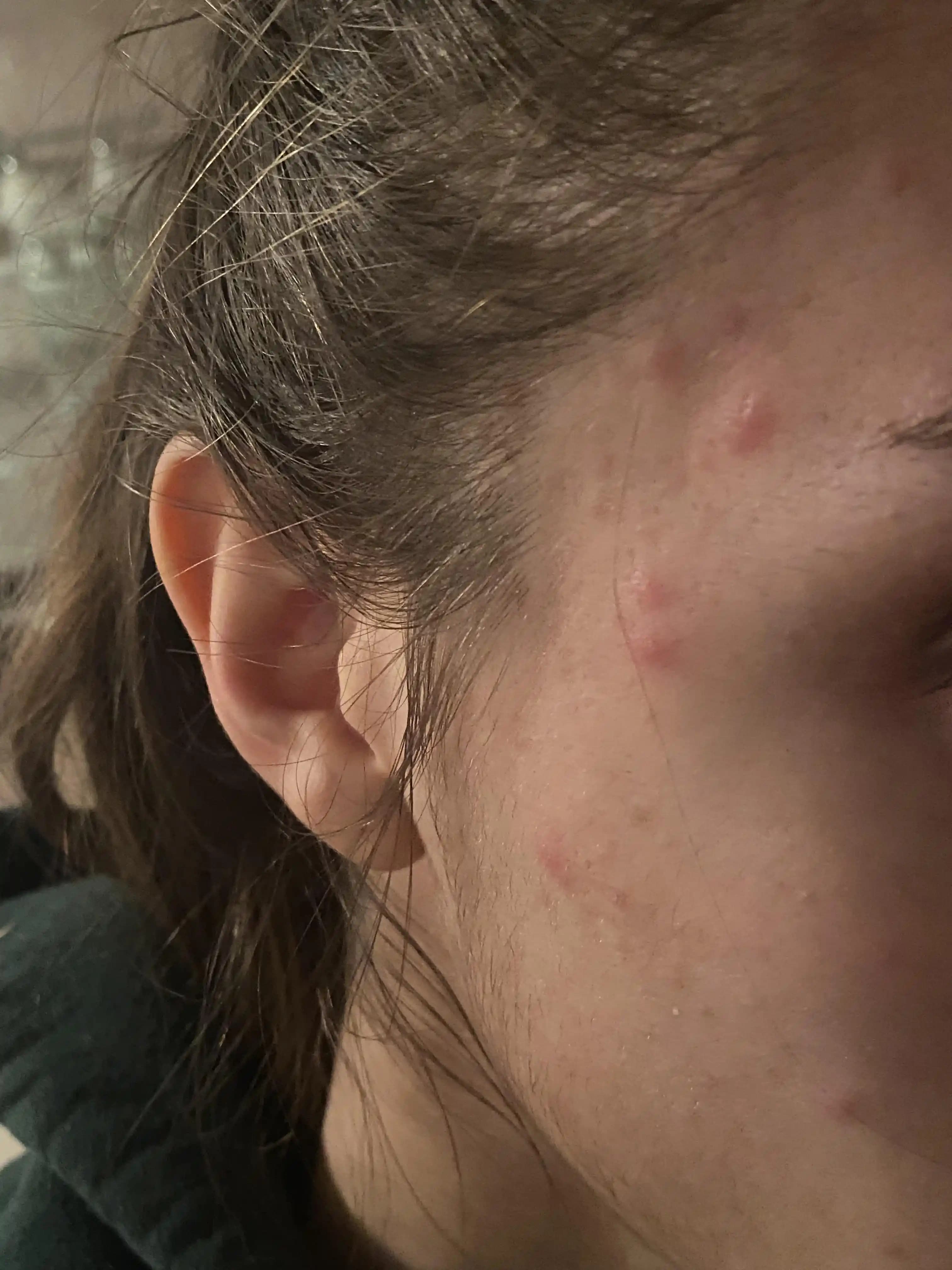 Saç Çizgisi ve Yüzde Aniden Ortaya Çıkan Sert Kabarcıkların Nedenleri ve Etkili Tedavi Yöntemleri