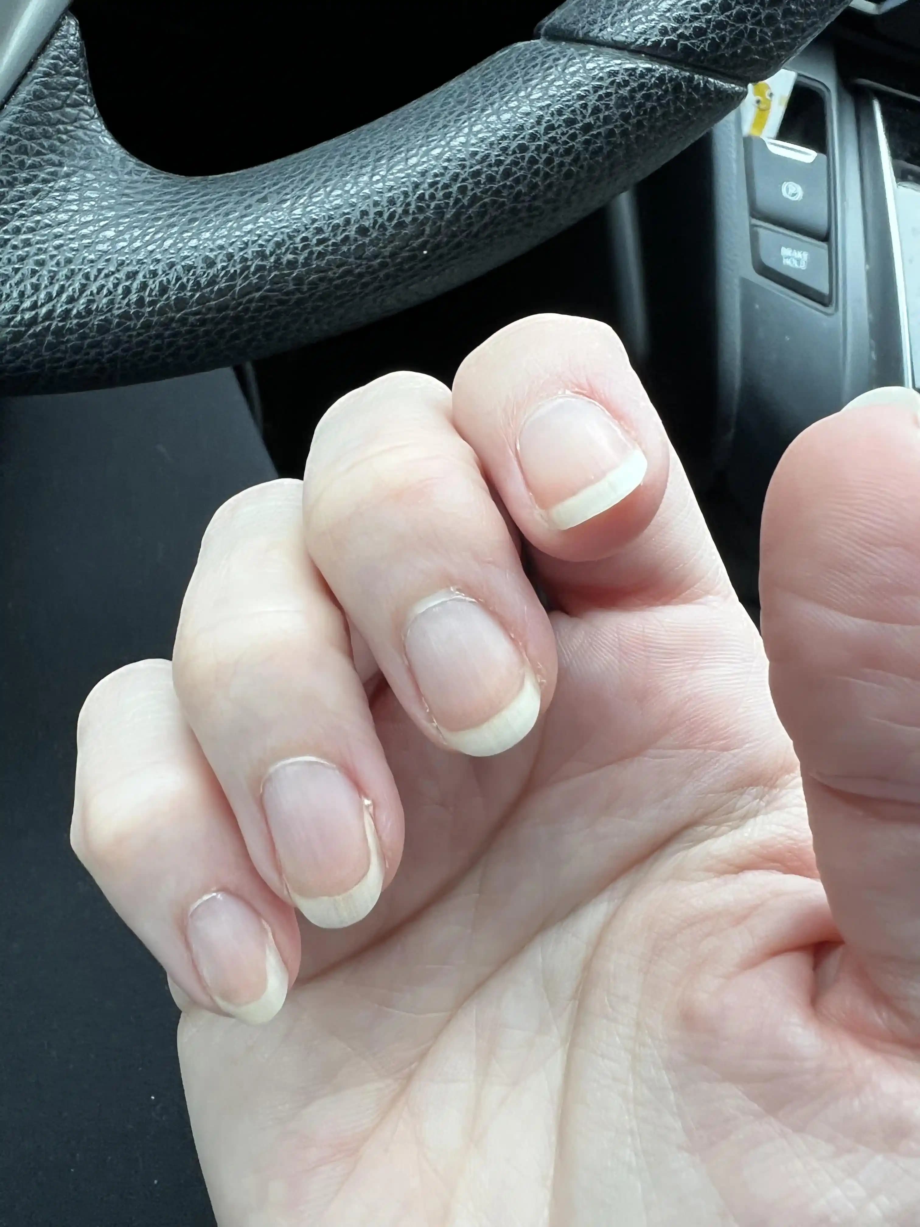 Tırnaklarda Yan Onikoliz: Nedenleri, Belirtileri ve Koruyucu Tedbirler