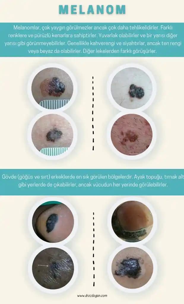 Vücut İçin Güneş Koruyucu Kullanımı ve Cilt Kanseri Önlemlerinin Önemi