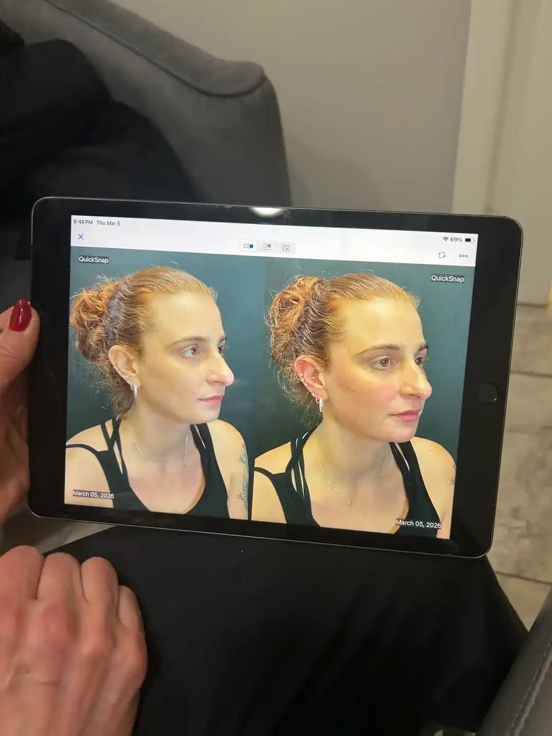 Yüz Dengeleme Dolgu Uygulamalarıyla İnce ve Doğal Yüz Hatları Oluşturma