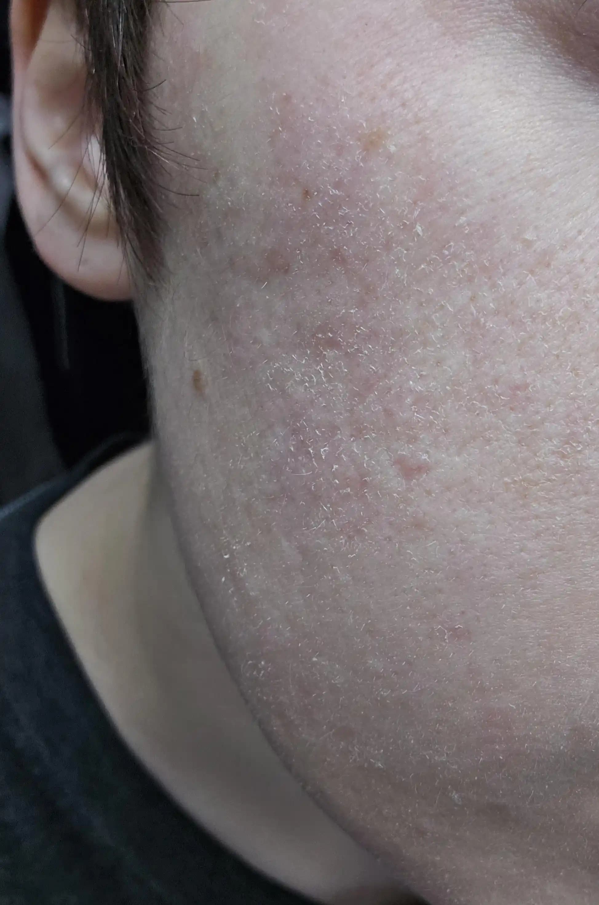 Yüzdeki Aşırı Kuru Cilt İçin Nemlendirici Dışında Etkili Çözümler ve Bakım Önerileri