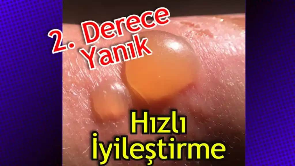 2. Derece Güneş Yanığı Ne Kadar Sürede Geçer ve En Etkili Tedavi Yöntemleri