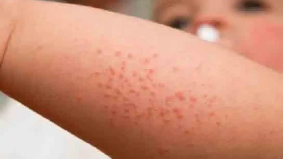 Bacak Arası Pişiğe Karşı Etkili Doğal Çözüm Yolları ve Koruma İpuçları 2024