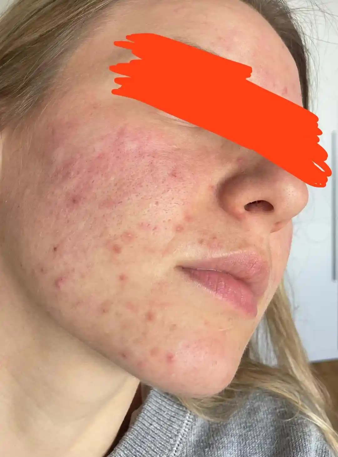 26 Yaşında Yetişkin Aknesi: Nedenleri, Tedavi Yöntemleri ve Uzman Görüşleri