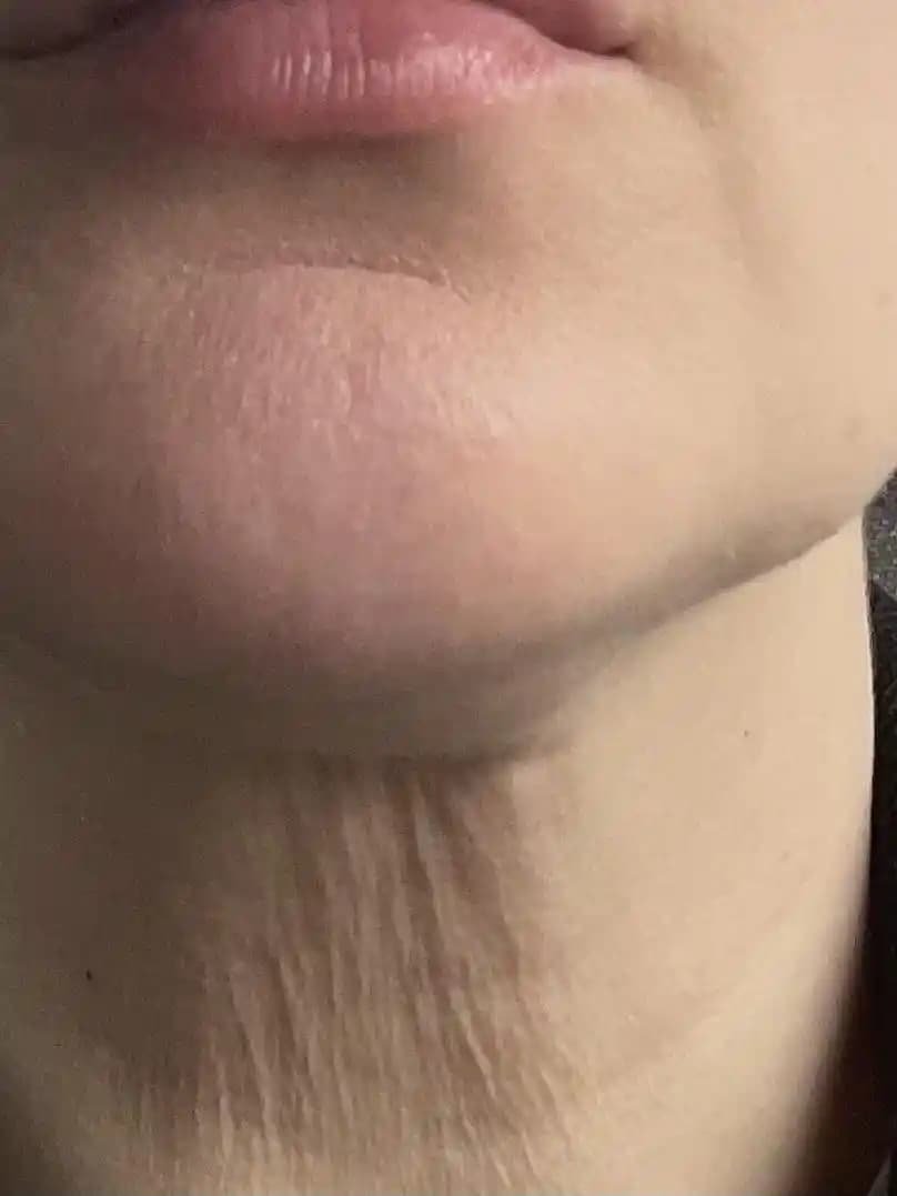 40 Yaşında Boyundaki Tavuk Derisi Görünümü: Nedenleri ve Etkili Tedavi Yöntemleri