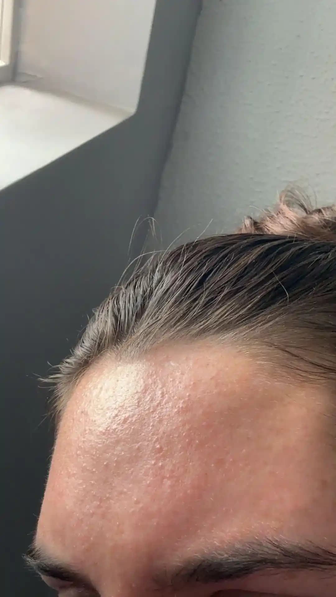 Alın Bölgesindeki Sivilce ve Pürüzlerin Tedavisinde Benzoyl Peroksit ve Cilt Bakım Rutinleri