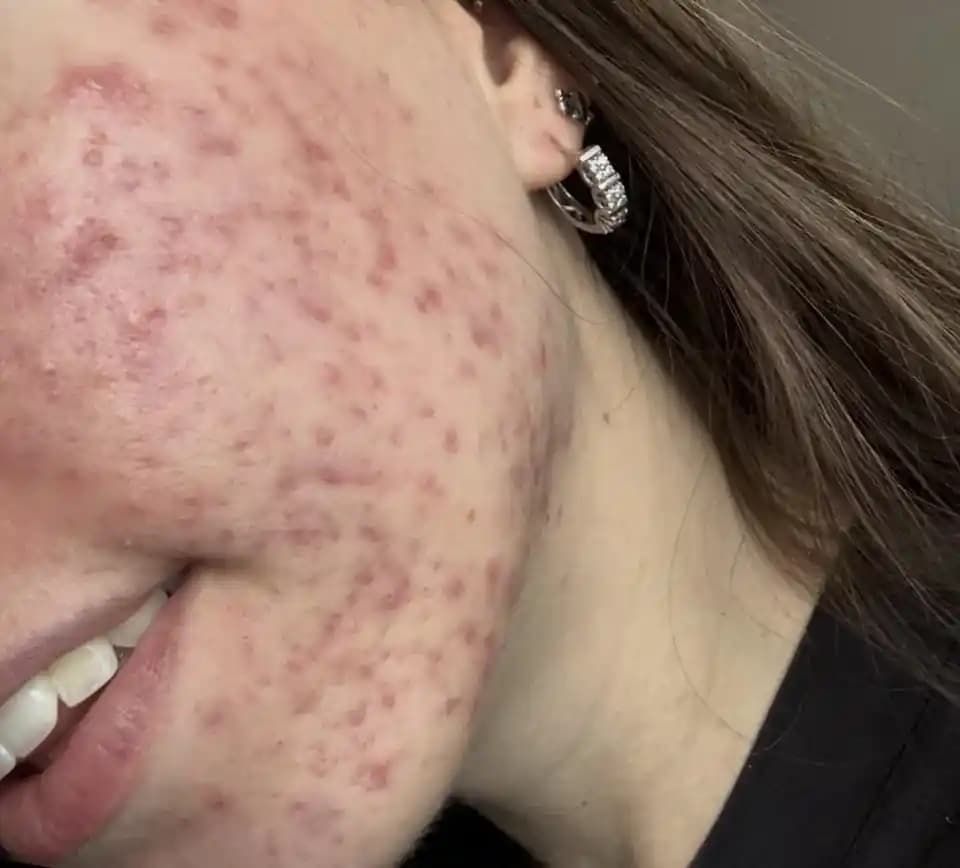 Azelaik Asit ile Akne Tedavisinde Etkili Kullanım ve Cilt Bakım Rutinleri