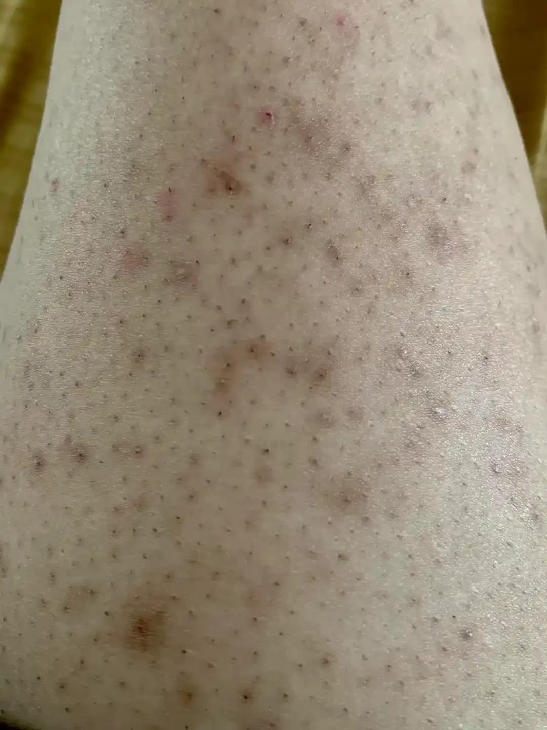 Bacaklarda Batık Tüy Problemi: Nedenler, Tedavi Yöntemleri ve Bakım Önerileri