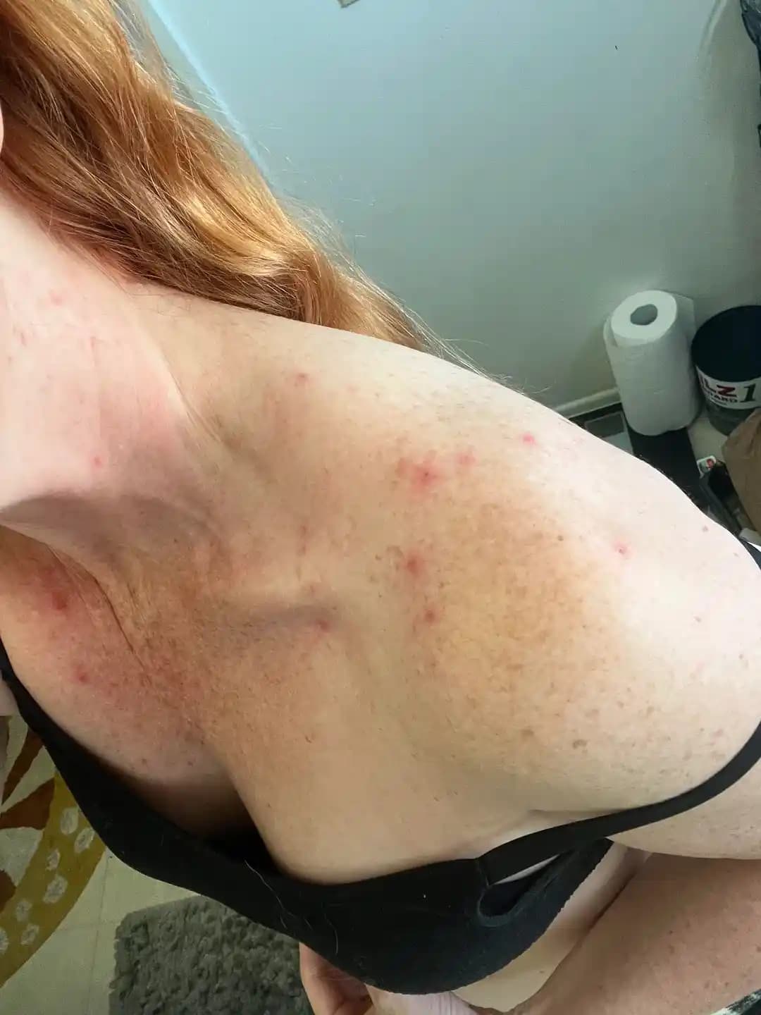 Boyun, Göğüs ve Omuz Bölgesindeki Akne Nedenleri ve Etkili Tedavi Yöntemleri