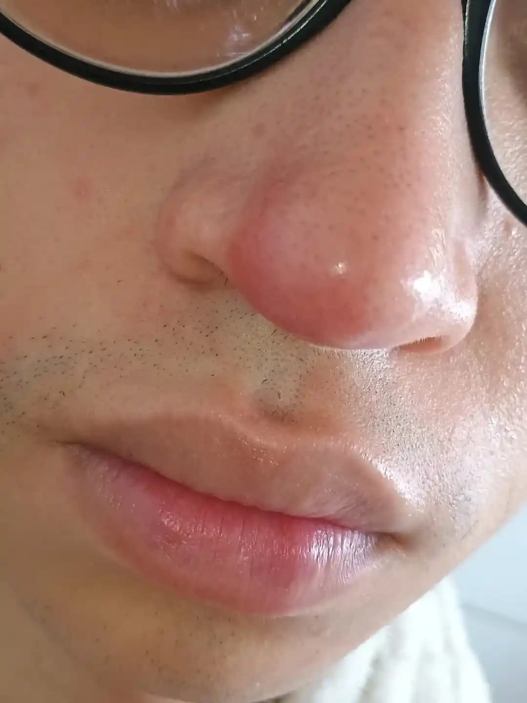 Burundaki Kör Sivilce ve Nazal Vestibülit: Tanı, Belirtiler ve Etkili Tedavi Yöntemleri