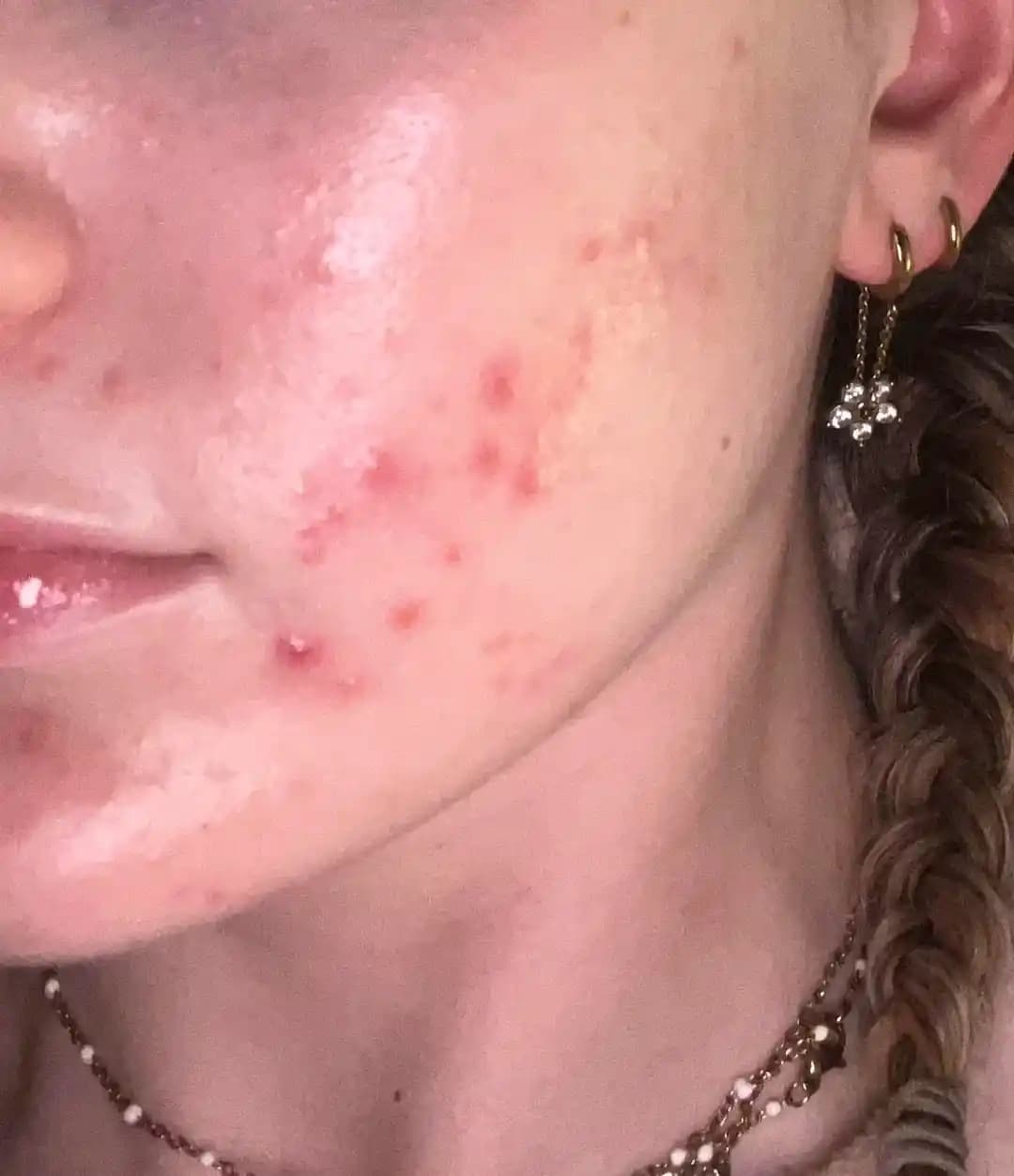 Cerave Yağ Bazlı Temizleyicinin Akne Üzerindeki Etkileri ve Cilt Tipine Uygunluk Analizi