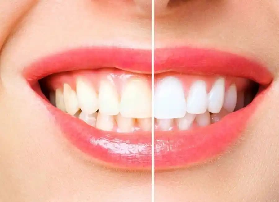 Çok Beyaz Dişlere Sahip Olmanın Yöntemleri ve Genetik Faktörlerin Rolü