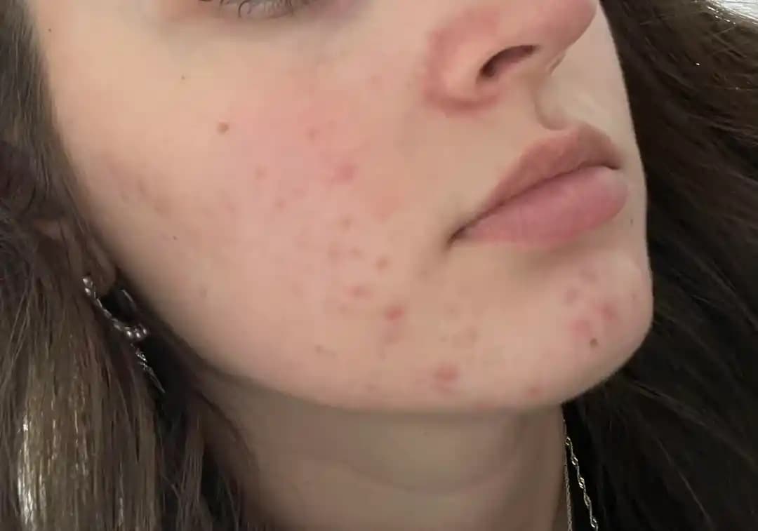 Hormonal Akne Tedavisinde Etkili Yöntemler, İlaçlar ve Cilt Bakımı Yaklaşımları