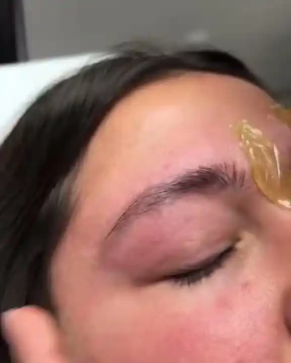 Kaş Ağdası Sonrası Deri Hasarı ve Morluk Görünümü: Nedenleri, Önlemleri ve Tedavi Yöntemleri