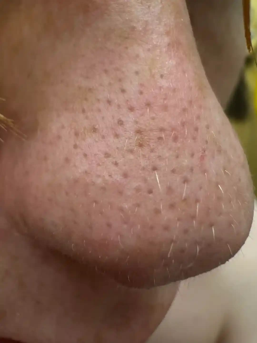 Sebase Filamentler: Neden Oluşur, Özellikleri ve Etkili Tedavi Yöntemleri