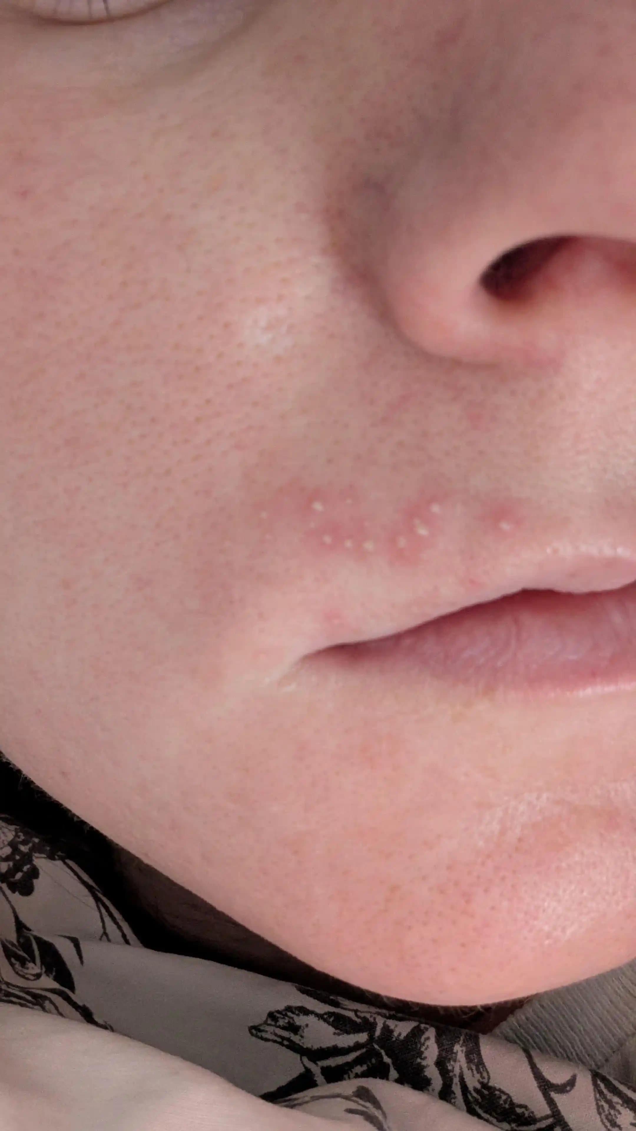 Yüz Ağdası Sonrası Dudak ve Yüz Bölgesinde Sivilce Oluşumu: Nedenler ve Çözüm Yolları