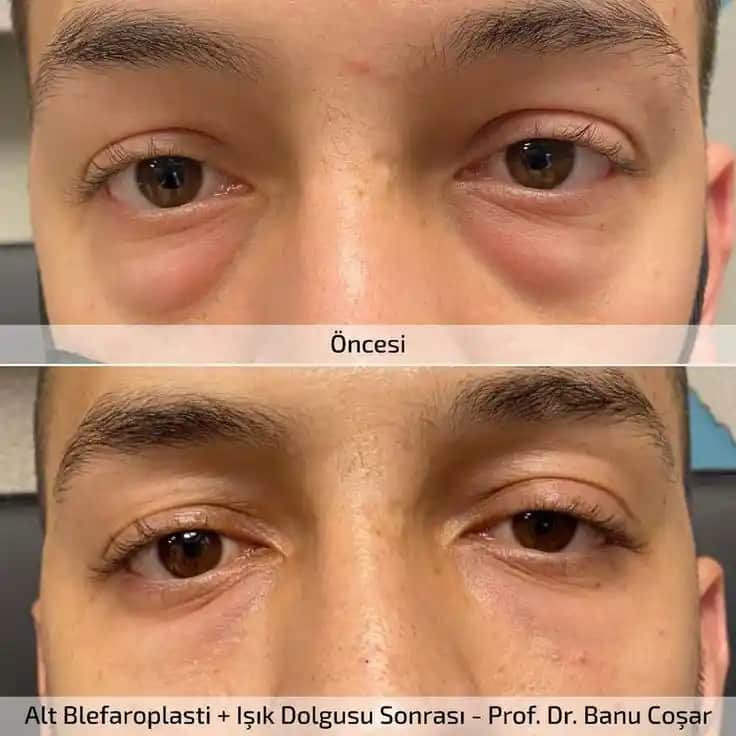 Göz Altı Gözenekleri ve Göz Çevresi Sağlığı için Gelişmiş Bakım Yöntemleri ve Doğru Uygulamalar