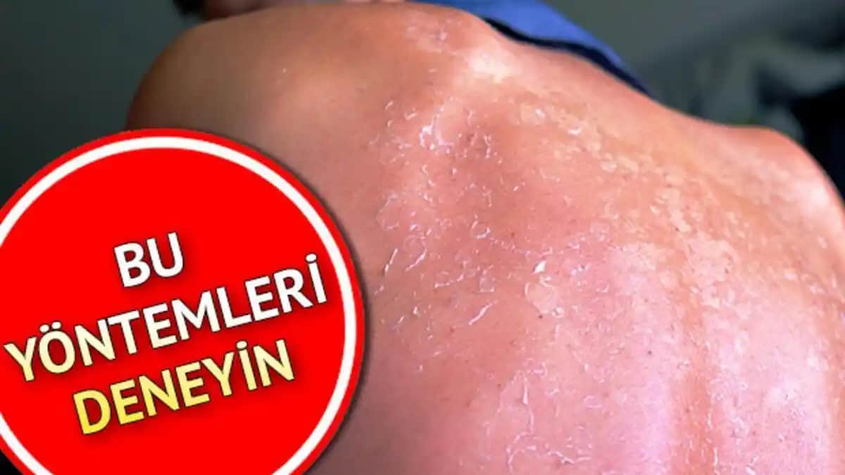 Güneş Kızarıklığı Ne Zaman Geçer Güneş Yanığı ve Cilt İyileşme Süreçleri