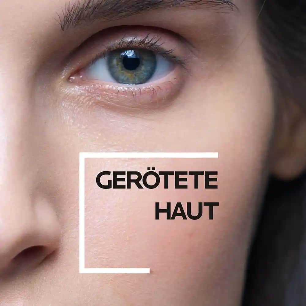 Güneş Koruma Faktörü 30 Nedir ve Cilt Sağlığını Nasıl Korur