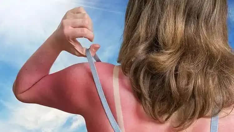 Güneş Yanığı Nedir, Belirtileri ve Etkili Korunma Yöntemleri Hakkında Bilgiler