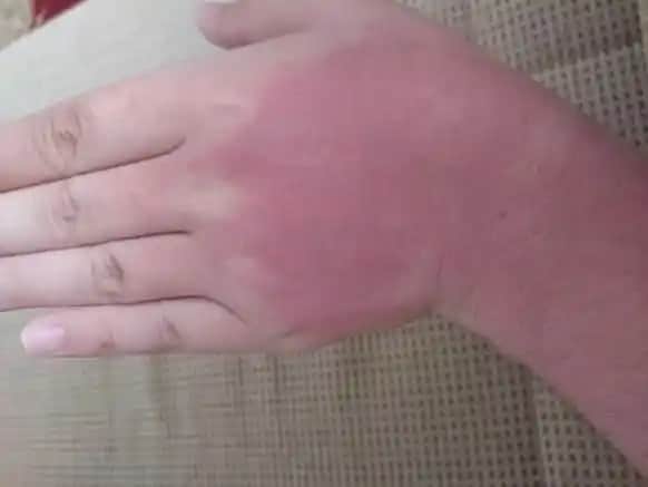 Güneş Yanığına İyi Gelen En Etkili Kremler ve Bakım Önerileri Hakkında Bilmeniz Gerekenler