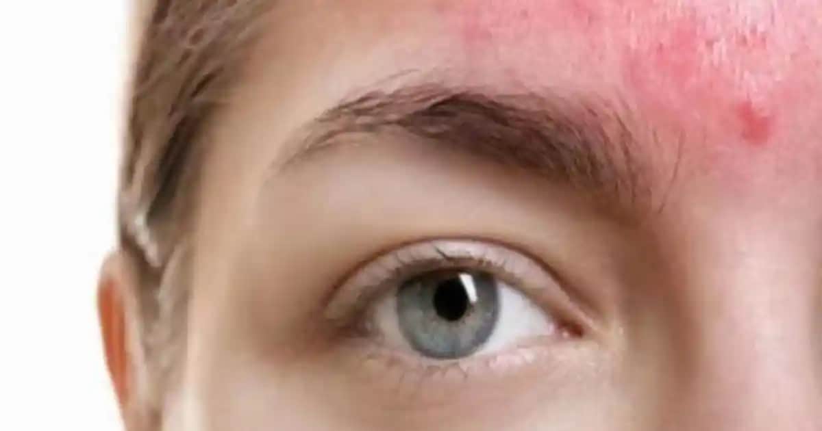 Hassas Ciltteki Kızarıklık Nasıl Geçer Uzman Tavsiyeleri ve Etkili Yöntemler