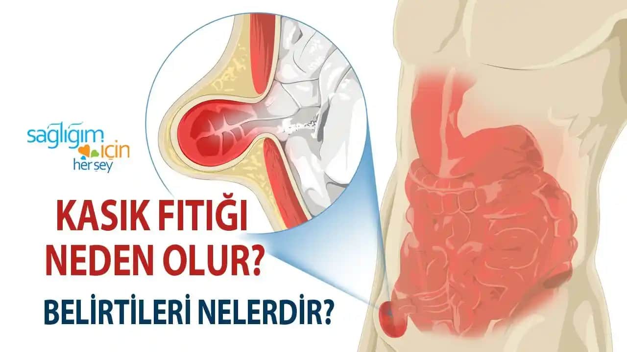 Kasık Pişiği Nedir, Belirtileri ve Etkili Tedavi Yöntemleri Hakkında Kapsamlı Bilgi