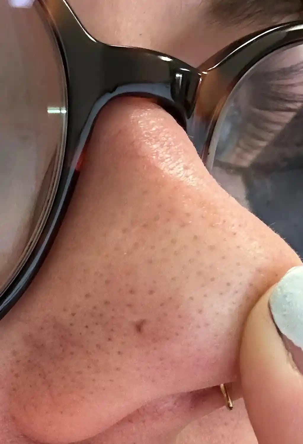 Burundaki Siyah Noktalar ve Sebase Filamentlerin Görünümünü Azaltma Yöntemleri