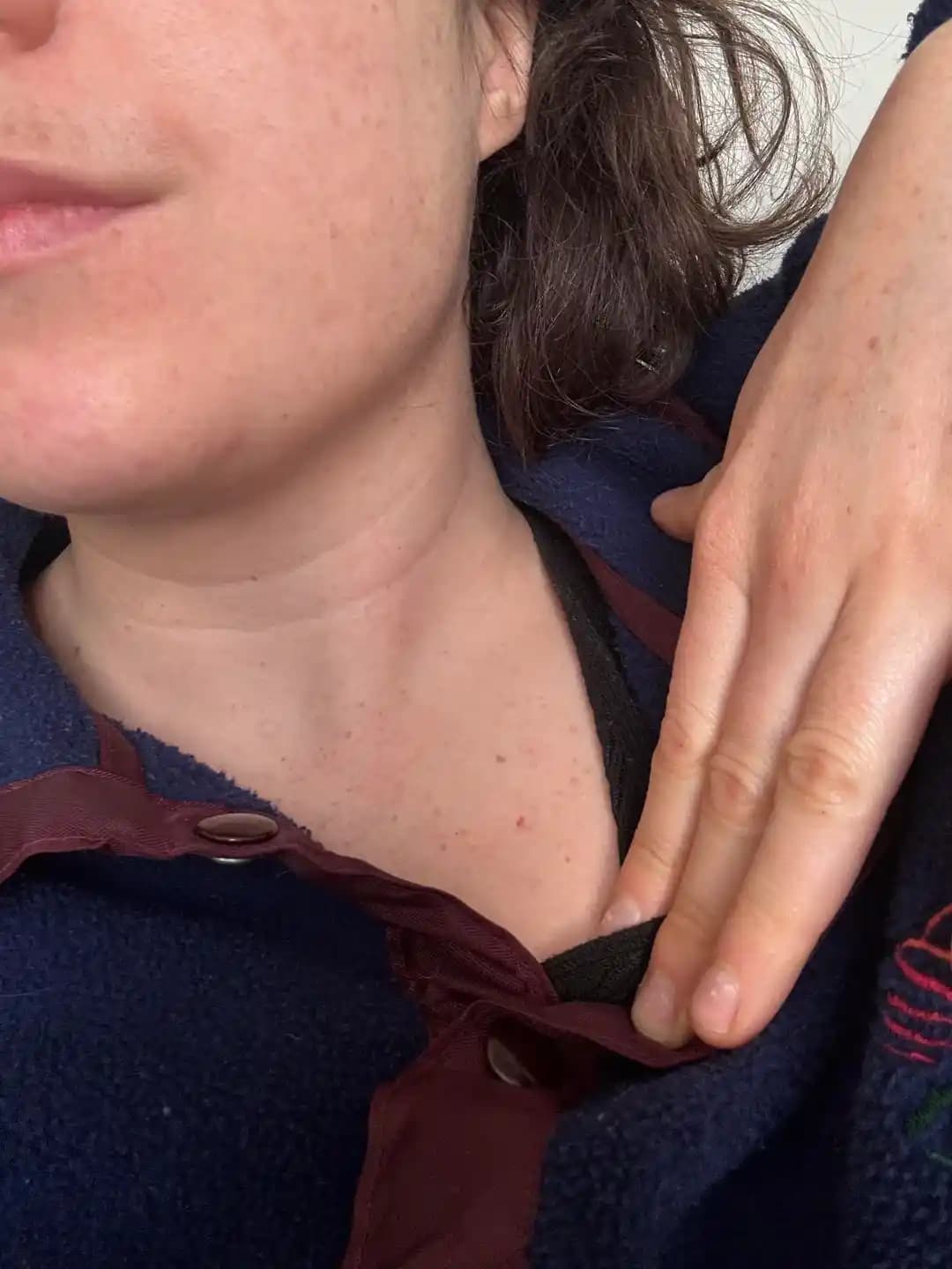 Cherry Anjiyomlar: Yaşlanma, Genetik ve Hormonal Faktörlerin Ciltteki Etkileri