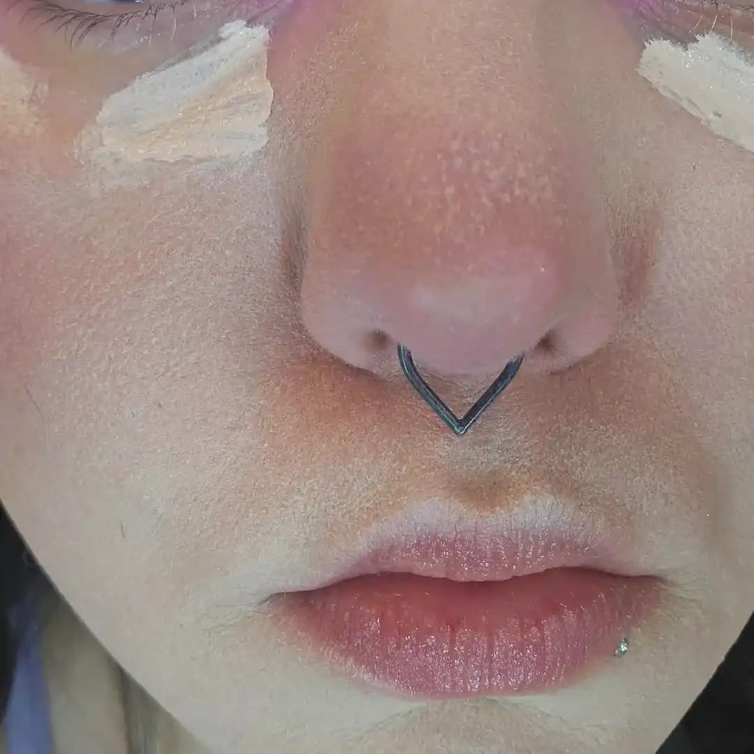 Fondötenin Ciltte İstenmeyen Doku Oluşturmasının Nedenleri ve Çözüm Yöntemleri