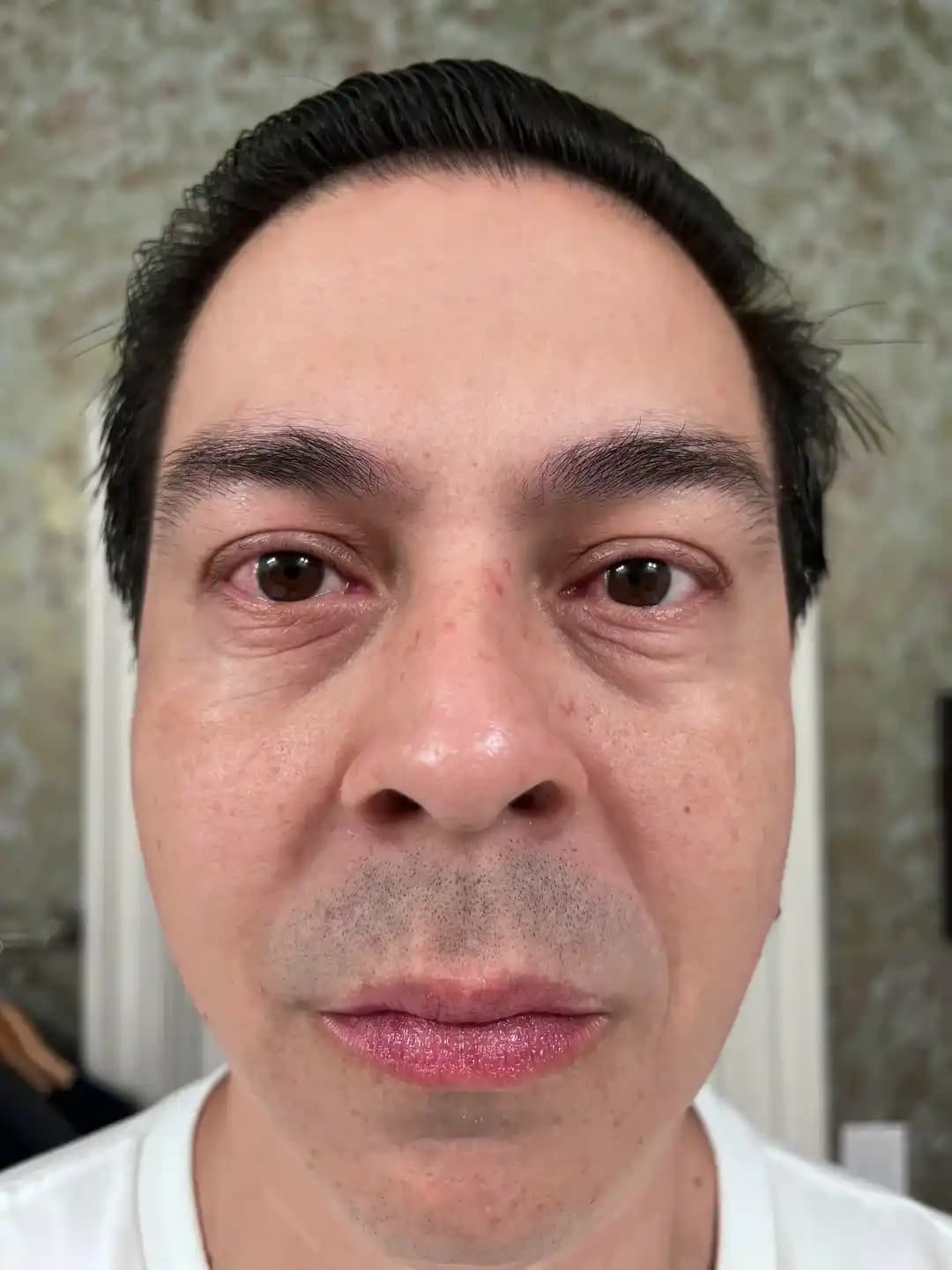 Medicube Zero Pore Pad Kullanımı ve 7 Ay Sonrası Cilt Sonuçlarının Değerlendirilmesi