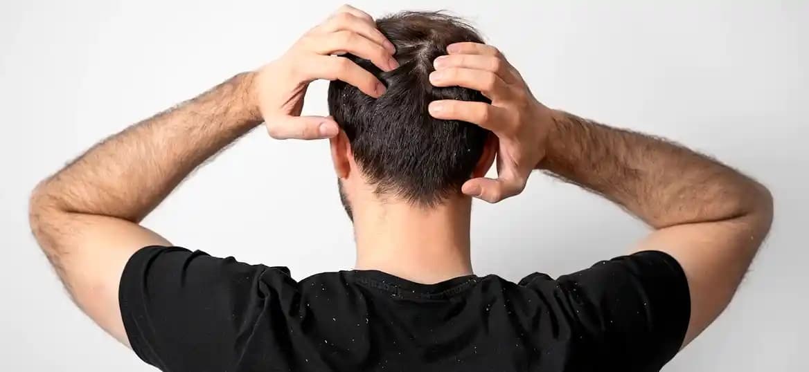 Saç Yukarı Toplandığında Saç Derisi Ağrısının Nedenleri ve Çözüm Yolları