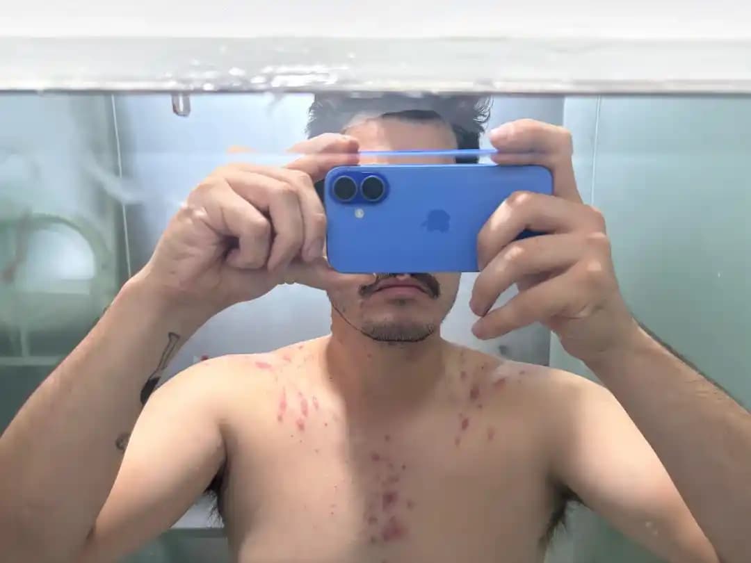 Şiddetli Akne Nedenleri, Tedavi Yöntemleri ve Dermatolog Görüşleri Üzerine Detaylı İnceleme