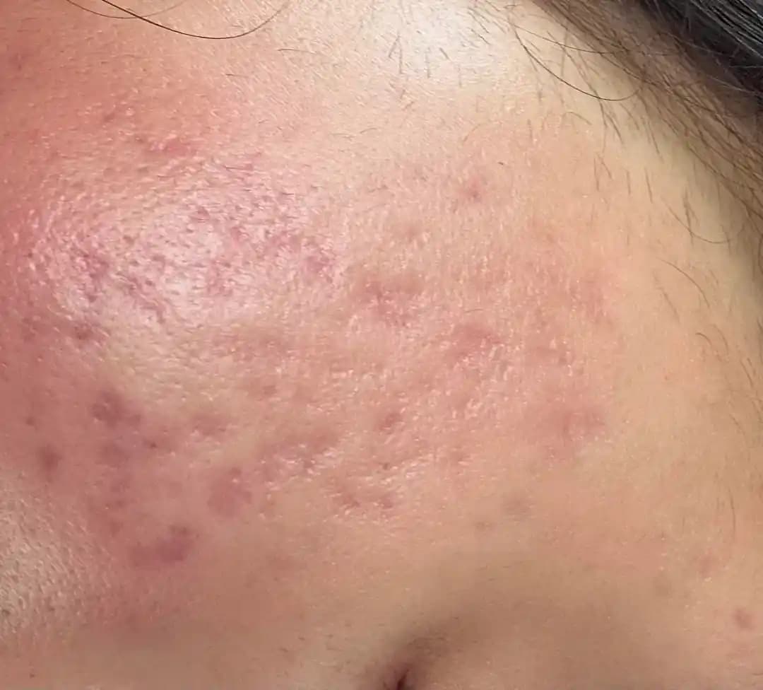 Akne İzleri: Türleri, Tedavi Yöntemleri ve İyileşme Süreci Hakkında Detaylı Bilgi