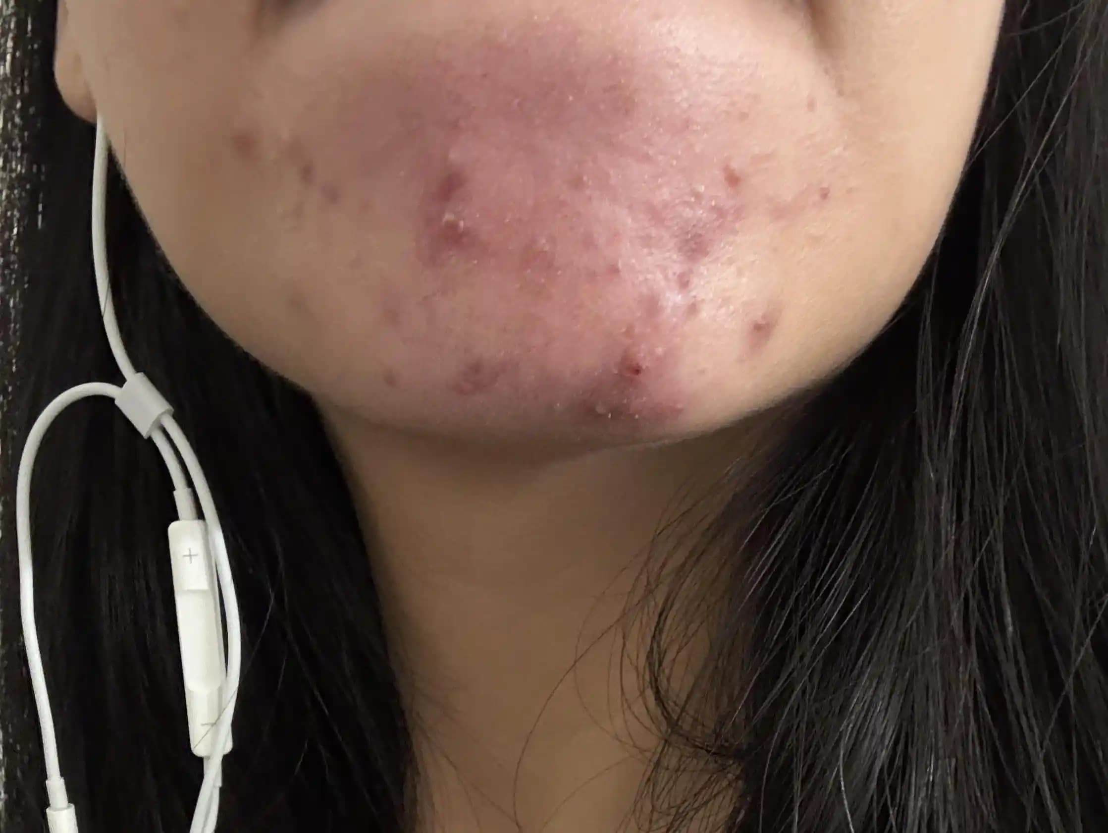 Akne Tedavisinde Evde Uygulanabilir Çözümler ve Etkili Cilt Bakım Rutinleri