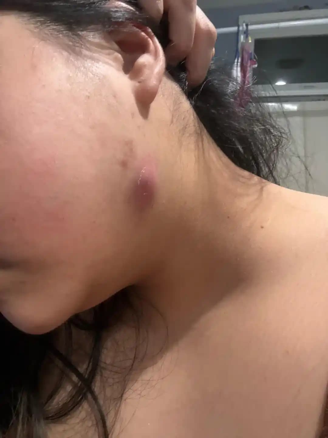 Büyük ve Ağrılı Sivilceler: Nedenleri, Tedavi Yöntemleri ve Uzman Görüşleri Üzerine Detaylı İnceleme