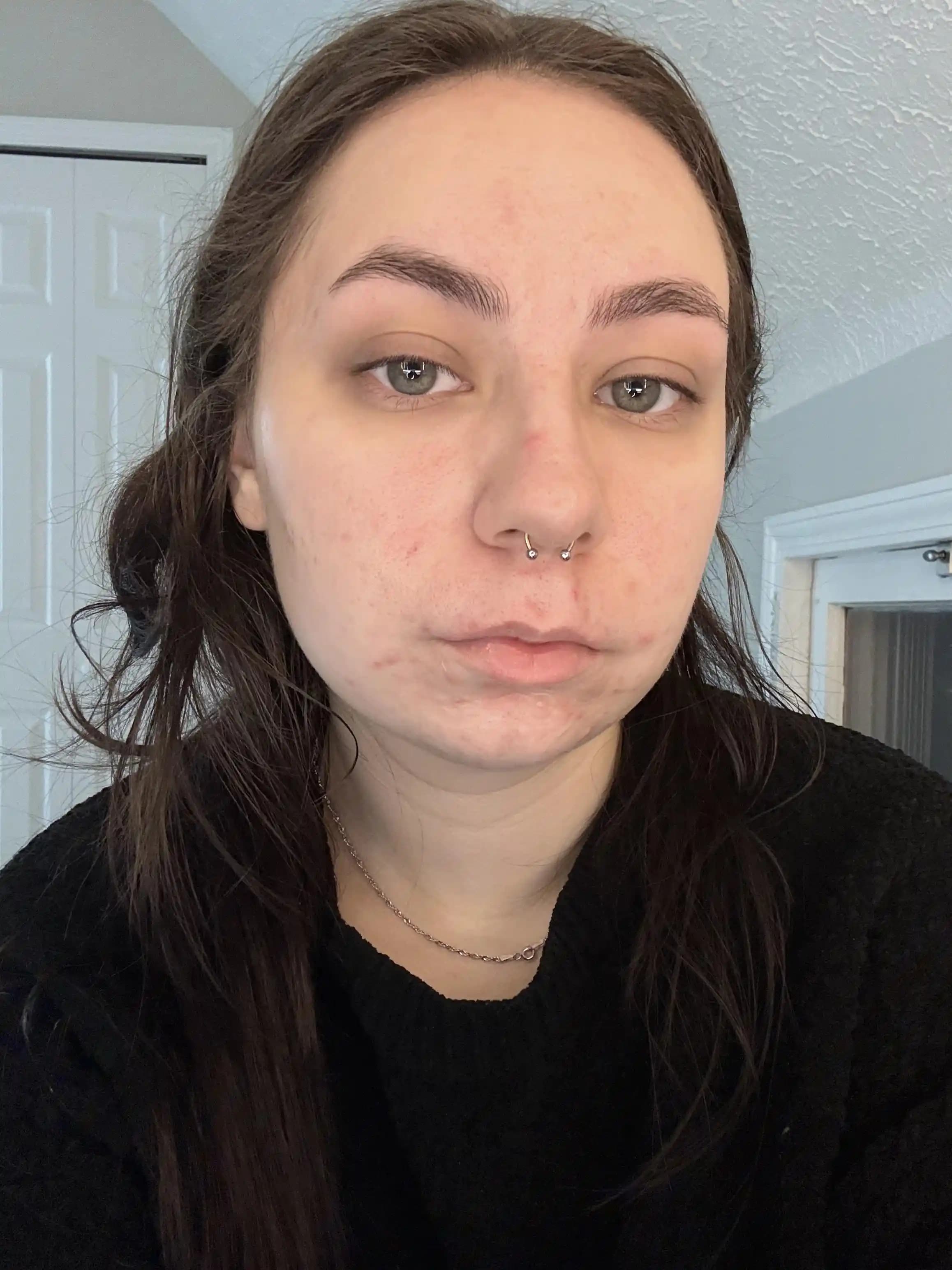 Hormonal Akne Tedavisi ve Psikolojik Etkileri: Kapsamlı Bir İnceleme