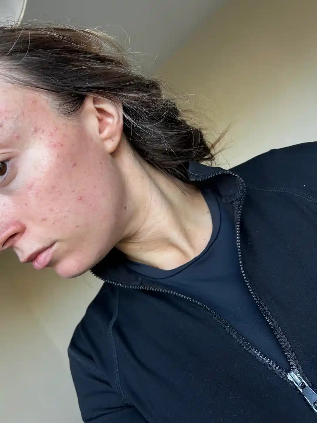 İngiltere Ziyareti Sonrası Sert Suyun Cilt Sorunlarına Etkisi ve Bakım Önerileri