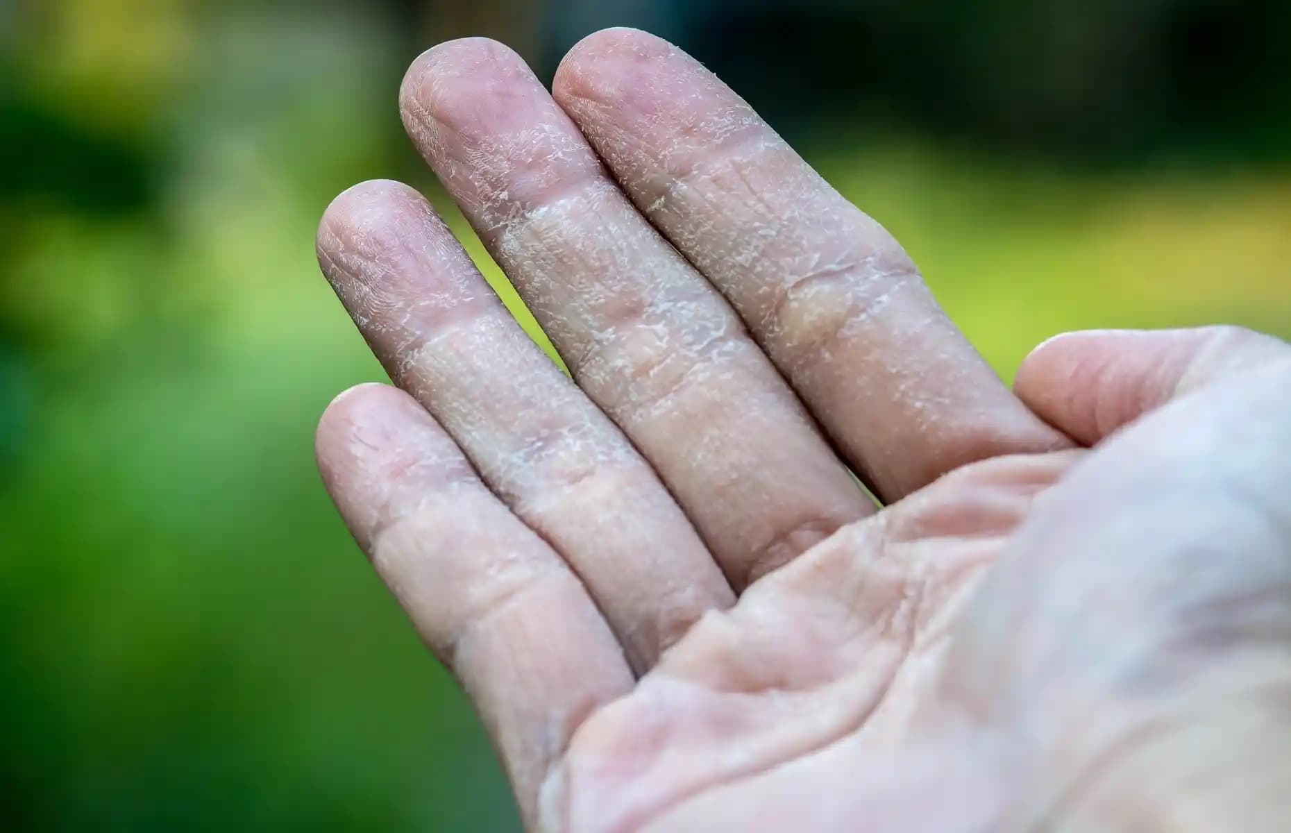 Kış Aylarında Eller İçin Yoğun Nemlendirme ve Dolgunlaştırma Yöntemleri
