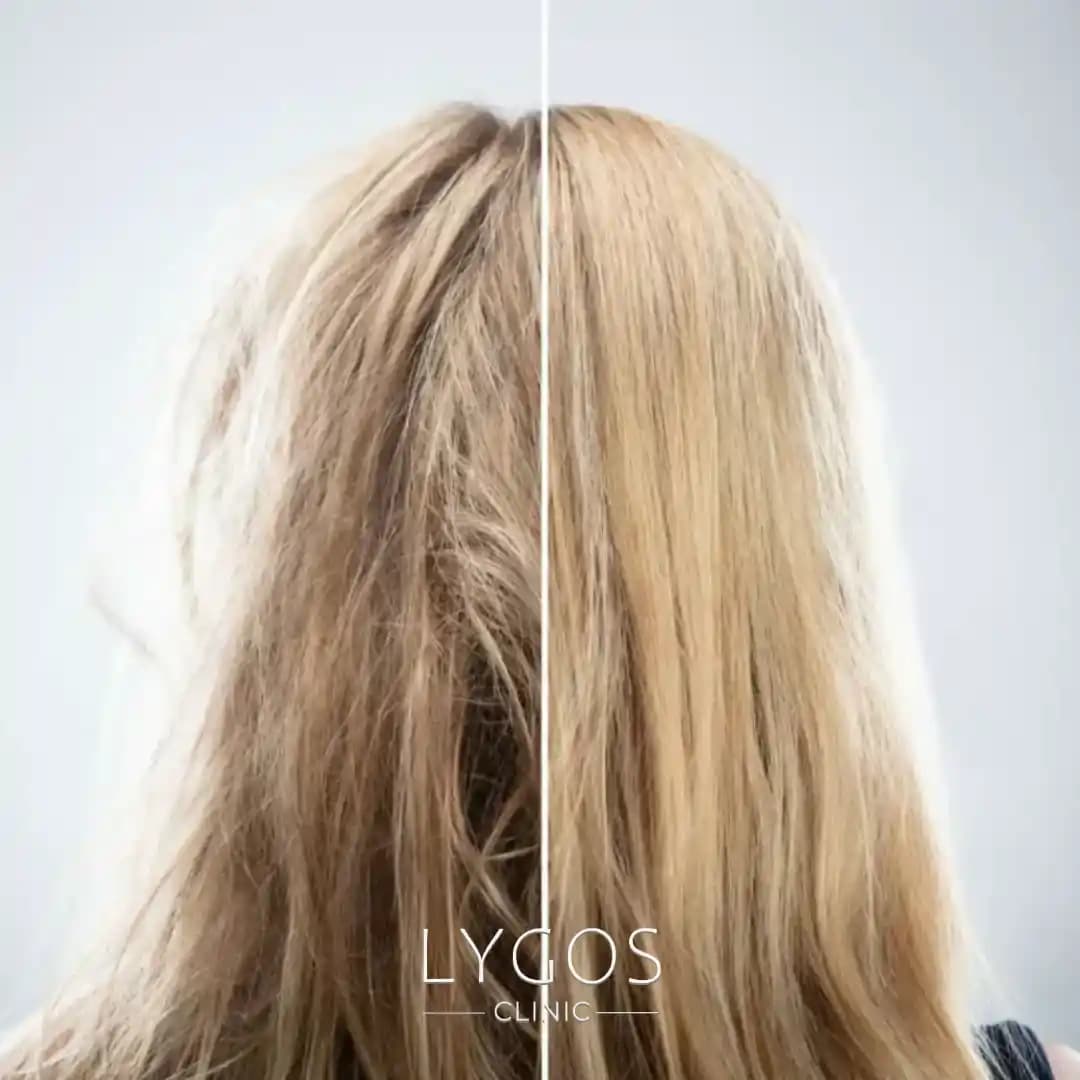 Saç Porozitesi ve Kimyasal İşlemlerin Saç Sağlığı Üzerindeki Etkileri: Yapısal Değişimler ve Bakım