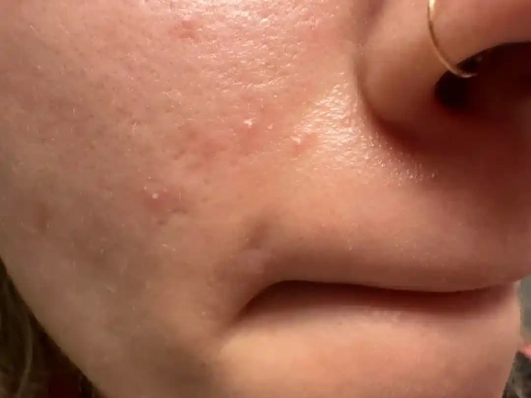 Tretinoin Kullanımında Yüzeysel Beyaz Püstüller: Nedenleri ve Tedavi Yöntemleri