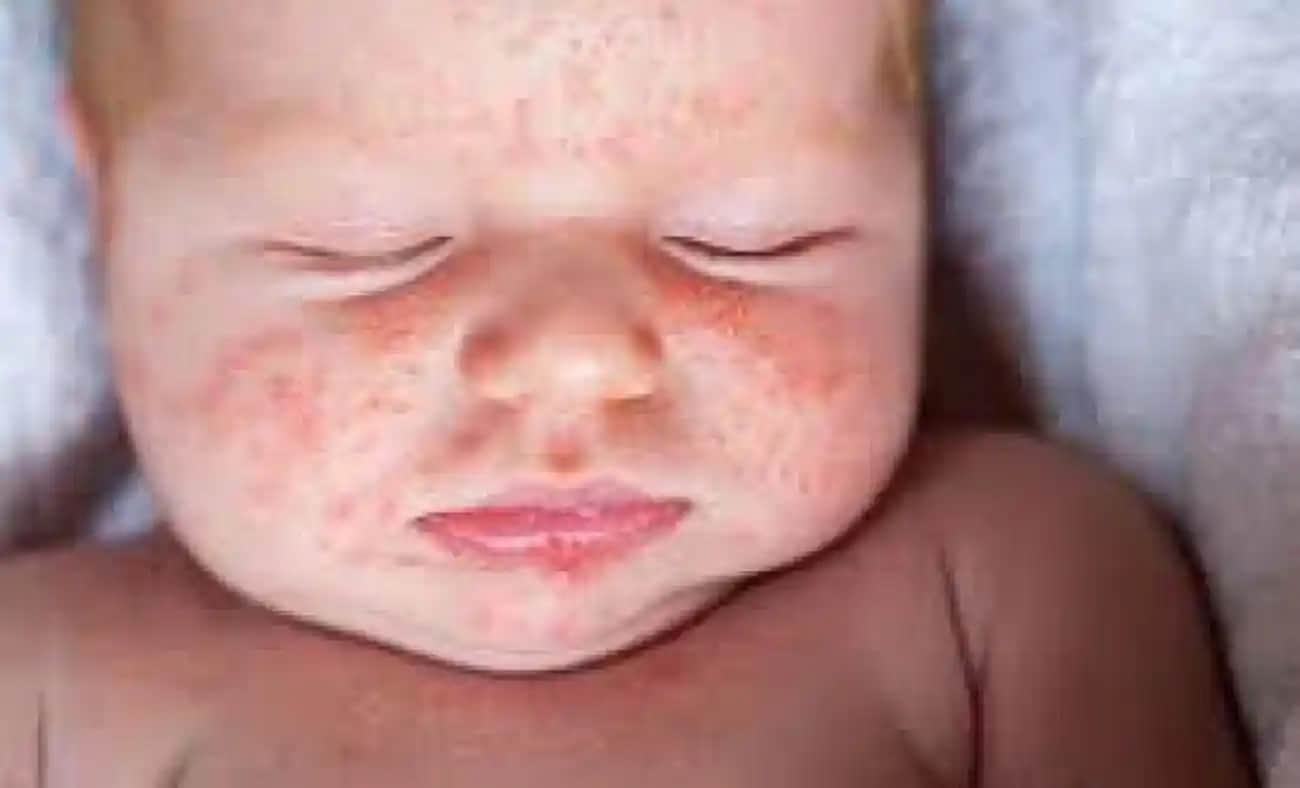 Bebeklerde Pişiğe İyi Gelen Doğal ve Etkili Çözüm Yöntemleri