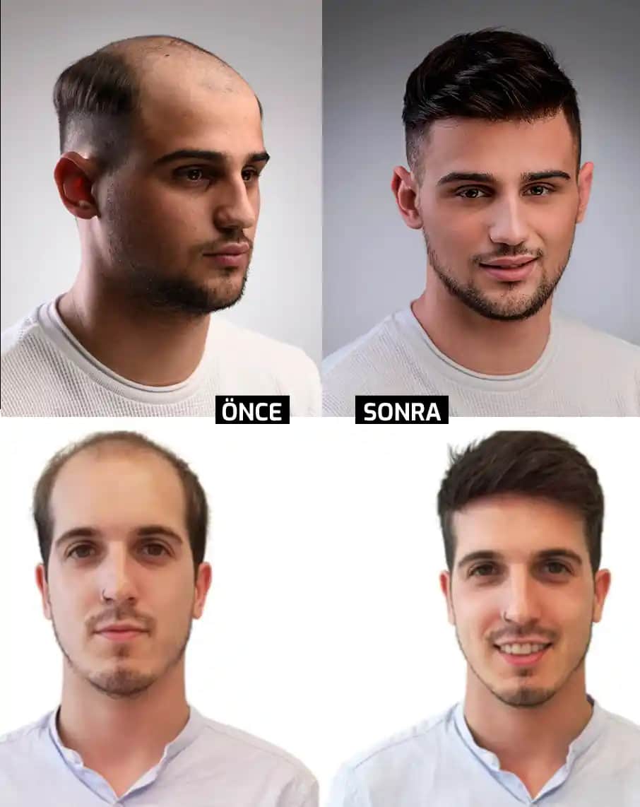 Erkek Protez Saç Uygulamaları: Doğal Görünüm ve Güncel Çözümler Hakkında Bilgi