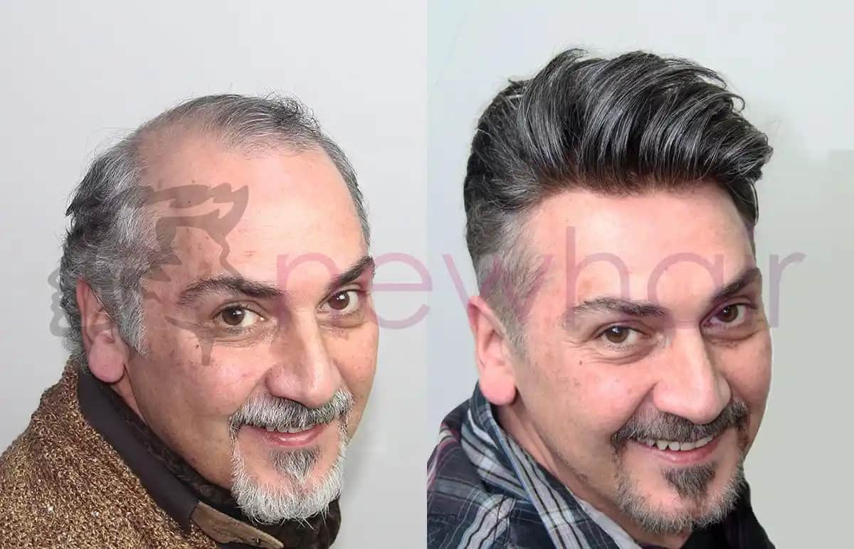 Erkekler İçin Protez Saç Çözümleri: Doğal Görünüm ve Uzman Uygulama Seçenekleri