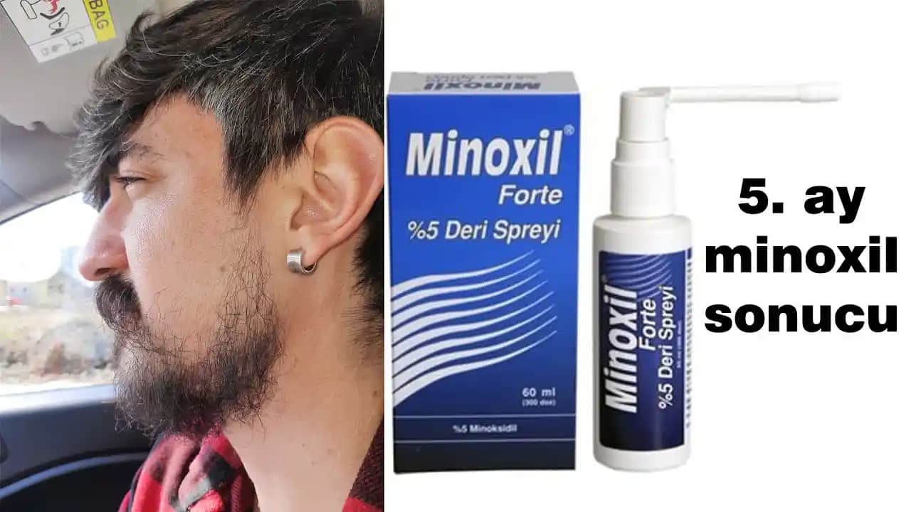 Minoksidil İçerikli Sakal Serumu: Sakal Gelişimini Destekleyen Etkili Çözüm