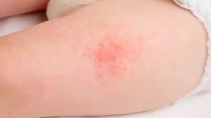 Pişik İçin Etkili Doğal Yöntemler ve Cilt Bakımı Tavsiyeleri