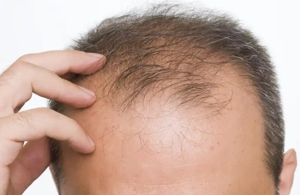 Saç Dökülmesini Önleme ve Sağlıklı Saçlar İçin Güncel Yöntemler Rehberi